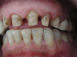 Corona de Procera sobre dientes naturales