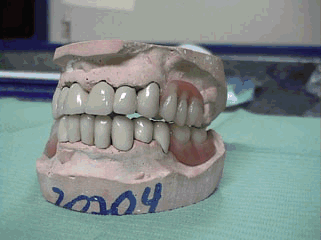 Prótesis combinada: Puente fijo sobre dientes naturales y esqueleto