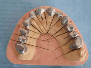 Rehabilitación de metal porcelana sobre dientes naturales